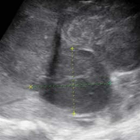 Ultrasound Scan Of The Abdomen A Heterogeneously Hypoechoic Solid Mass