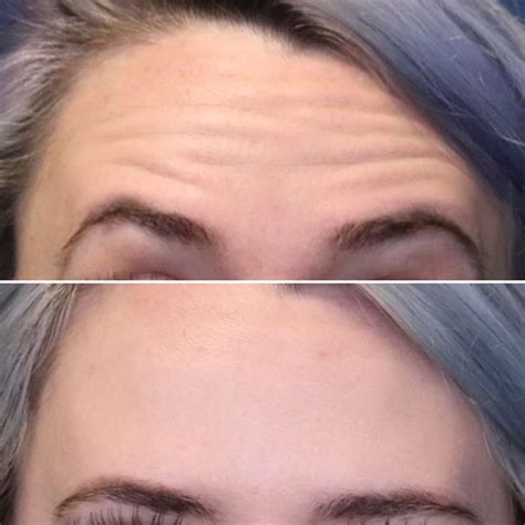 Pin On Botox Before After