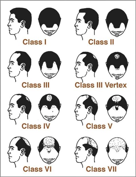 Hair Loss Stages And The Norwood Scale Hairtattooca