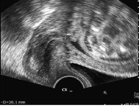 Transvaginal Ultrasound Revealing The Distance Between The Internal Os