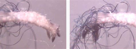 Morgellons Pictures Video And Information Plus Free Brochure