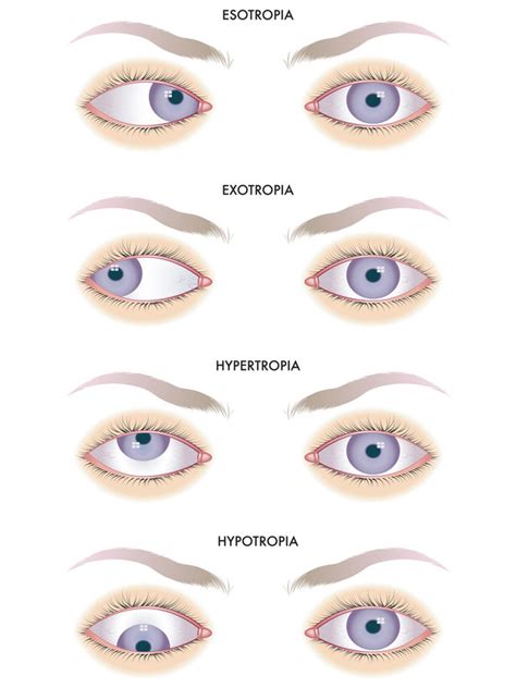 Strabismus Stereo Optical