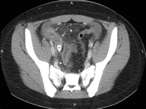 Axial Intravenous Contrast Material Enhanced Ct Scan Demonstrates Acute
