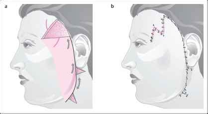 Forehead Rotation Facial Plastic Surgery European Medical