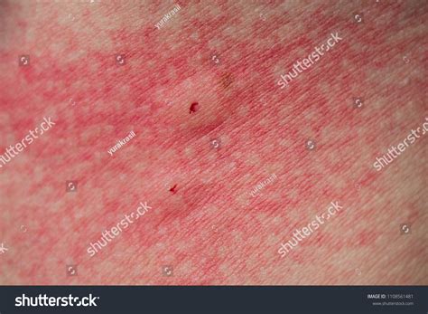 34 Spider Insect Bite Rash Images Stock Photos And Vectors Shutterstock