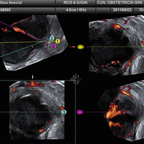 Tomographic Ultrasound Imaging Tui Displays The Lesion In Several