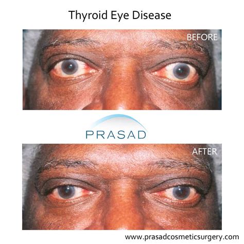 Thyroid Eye Disease Surgery Graves Eye Disease Surgery