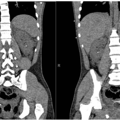 Computed Tomography Scan Of The Abdomen And Pelvis Without Iv Contrast