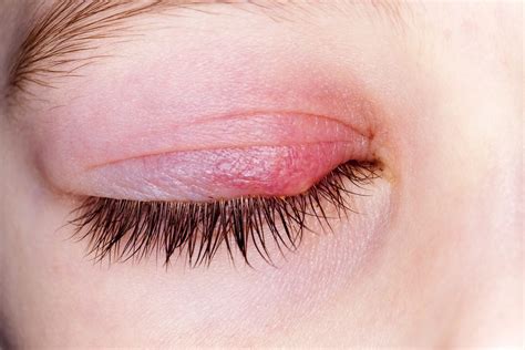 Blepharitis Overview Causes Symptoms Treatment