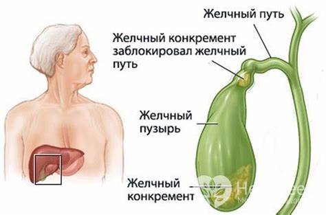 Желчь каменная болезнь диета Що таке жовтяниця? Типи і види жовтяниці, симптоми і лікування Що таке жовтяниця? Типи і види жовтяниці, симптоми і лікування Желчь каменная болезнь диета
