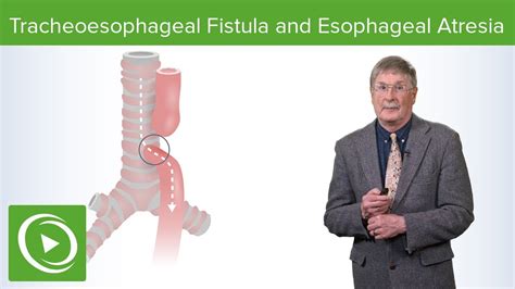 Tracheoesophageal Fistula And Esophageal Atresia Lecturio Medical