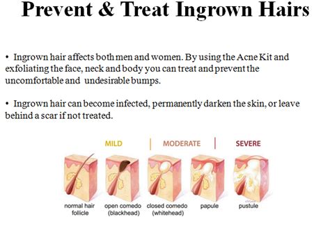 Find out how to prevent them. How To Prevent Ingrown Hairs