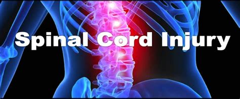 A Spinal Cord Injury Chiropractor San Diego Dr Steve Jones