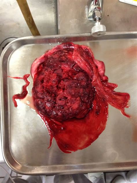 Histologic and morphometric study of human placenta in gestational diabetes mellitus. Embriología ENMH: Práctica 5 Anatomía de Placenta