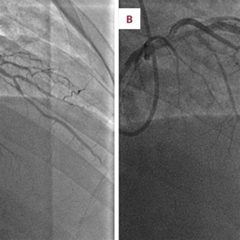 A Oct Showing Intramural Hematoma B Angiogram Of The Coronary