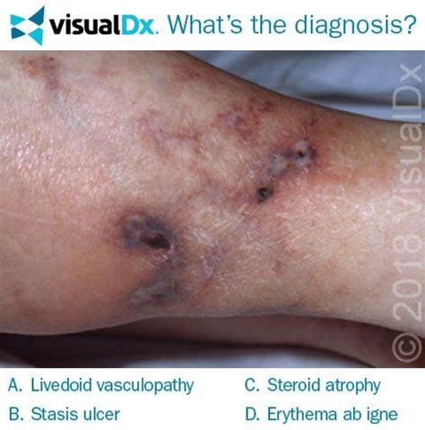 Womans Net Like Leg Lesions Are Painful Scarring Lets Diagnose Visualdx