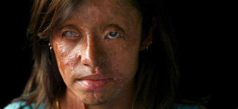 Colombia Demands Govt Action Following Pair Of Acid Attacks Against Women