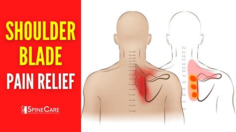 How To Fix Your Shoulder Blade Pain For Good Youtube