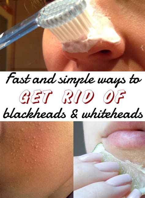 Home Remedies To Get Rid Of Blackhead Naturally At Home Veryhom