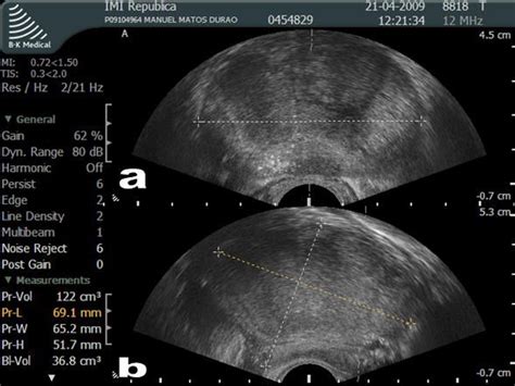 Wk 6 Prostate Prostate Enlargement Diagnostic Medical Sonography