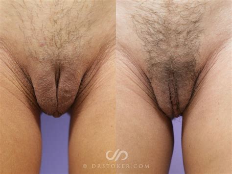 Labiaplasty Labia Majora Reduction Before And After Pictures Case