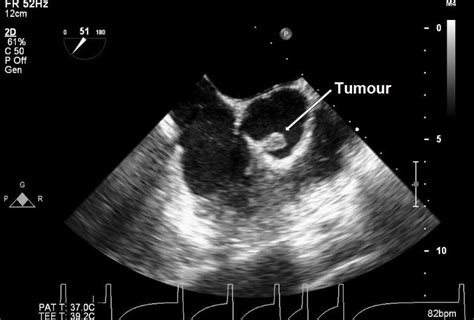 Papillary Fibroelastoma Of The Aortic Valve A Case Report And