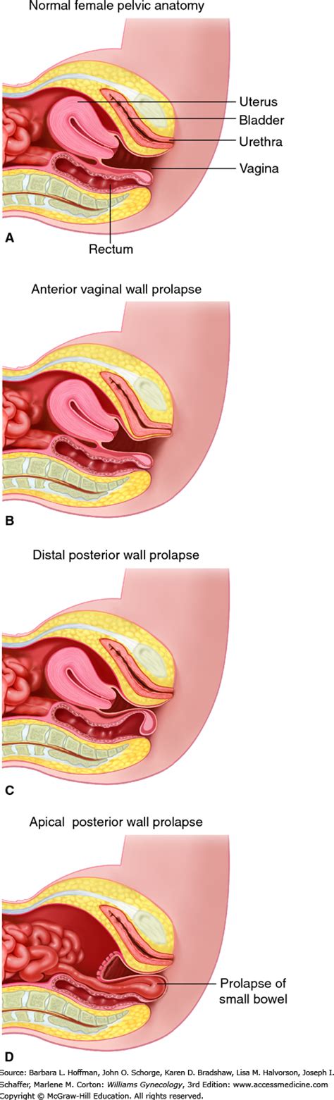 Posterior surface of bodies of pubic. CHAPTER 24: Pelvic Organ Prolapse | Obgyn Key