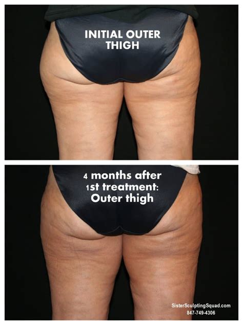Coolsculpting Before And After Photos Riverside Medical S C