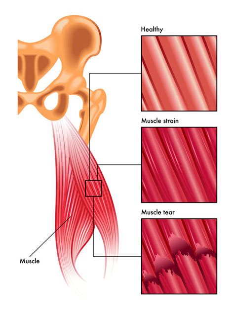 5 Steps To Quickly Recover From A Pulled Back Muscle