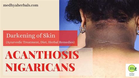 Acanthosis Nigricans Treatment The Best Ayurvedic Tips For Dark Neck