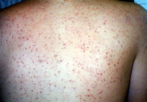 Dermatology Atlas Of Contact Dermatitis And Drug Eruptions Part Free