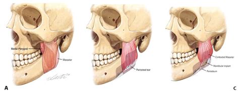 Masseter Muscle Reattachment After Mandibular Angle Surgery World