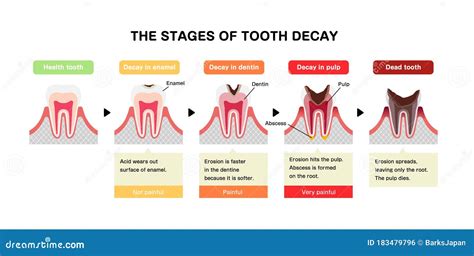 The Stages Of Tooth Decay Flat Vector Illustration Stock Vector