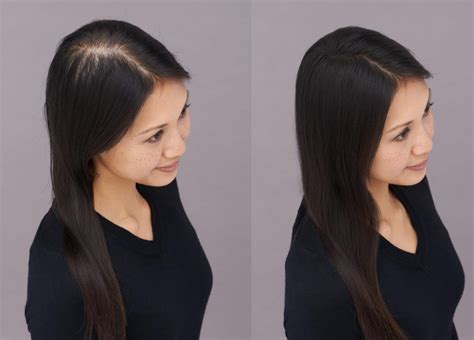 Top 48 Image Normal Hair Part Vs Thinning Vn