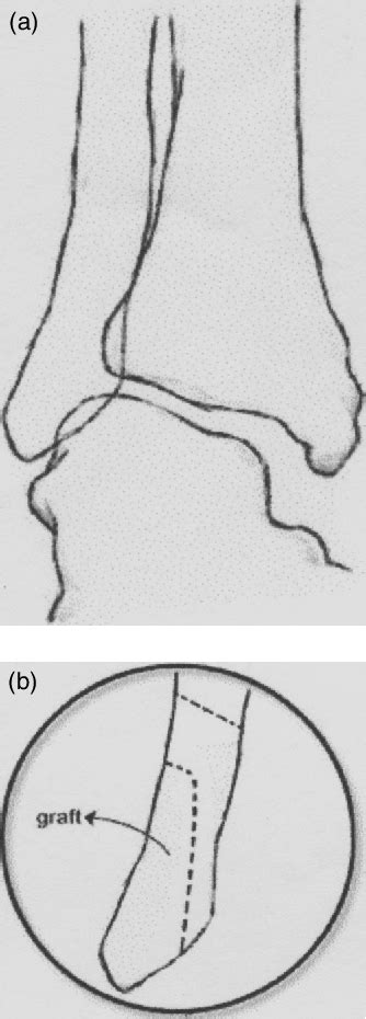 Figure 1 From Correction Of Severe Valgus Deformity During Ankle