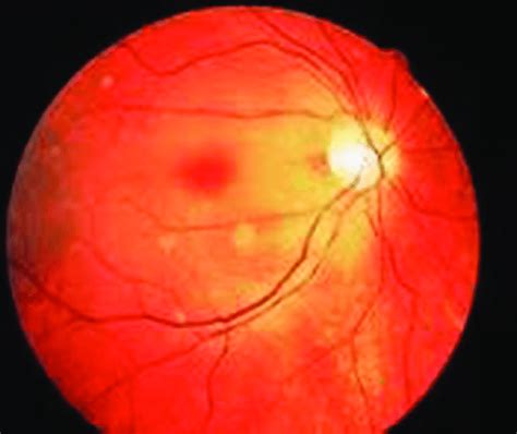 Central Retinal Artery Thrombosis Resulting In Cherry Red Spot