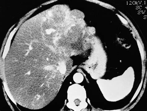 Imaging Of Atypical Hemangiomas Of The Liver With Pathologic
