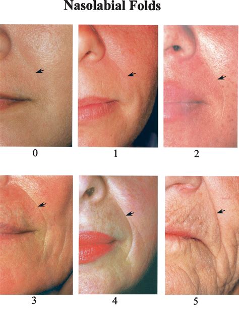Pdf A Classification Of Facial Wrinkles Semantic Scholar