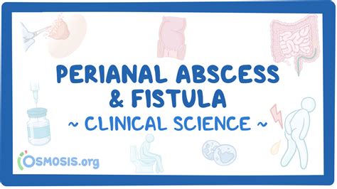 Perianal Abscess And Fistula Clinical Sciences Osmosis Video Library
