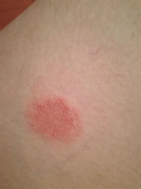 Any Idea What This Is Appeared On My Thigh Randomly Have Been