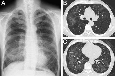 Exogenous Lipoid Pneumonia Successfully Treated With Bronchoscopic