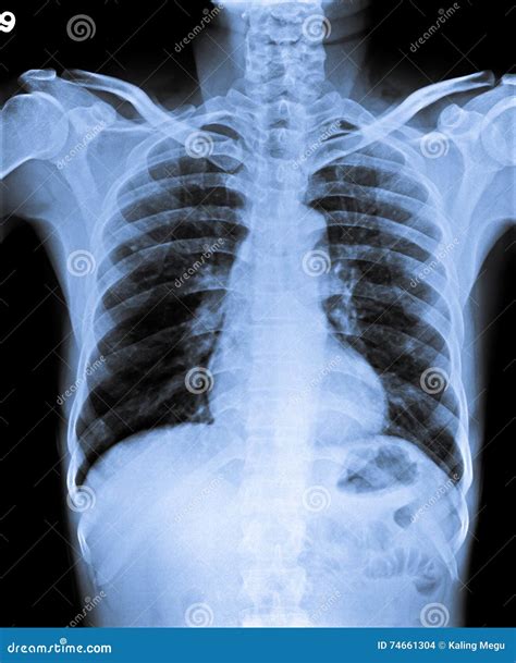 Normal Chest X Ray Stock Photo Image Of Investigation 74661304