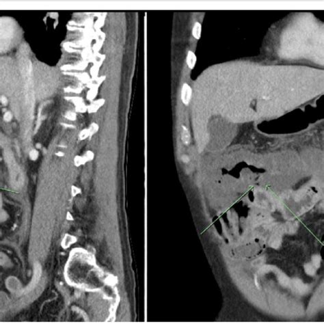 Abdominal Ct Sagittal And Coronal Views Showing Mural Thickening Of