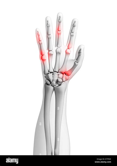 Las Articulaciones De La Mano Humana Mostrando La Artritis Equipo De