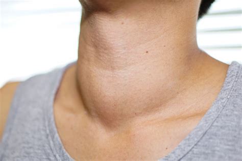 Asian Lady Woman Patient Have Abnormal Enlargement Of Thyroid Gland