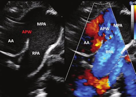 Transthoracic Echocardiography With Colour Compare In Parasternal Short