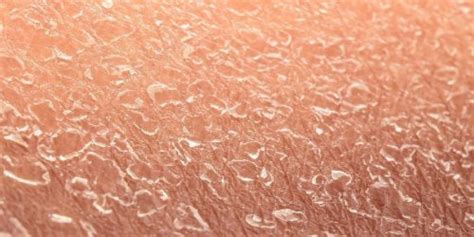 What Could Be Causing Your Dry Skin Delta 5