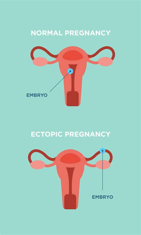 What You Need To Know About Ectopic Pregnancy