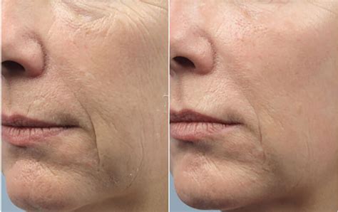 Skin Rejuvenation Before And After Lightrx Medspa