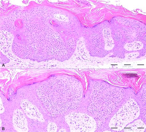 Clonal Seborrheic Keratosis Histology Shows A Clonal Seborrheic Sexiz Pix